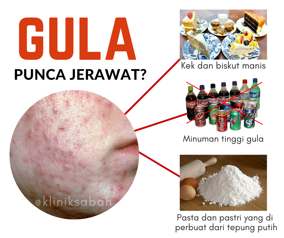 Kesan Gula Berlebihan Terhadap Jerawat